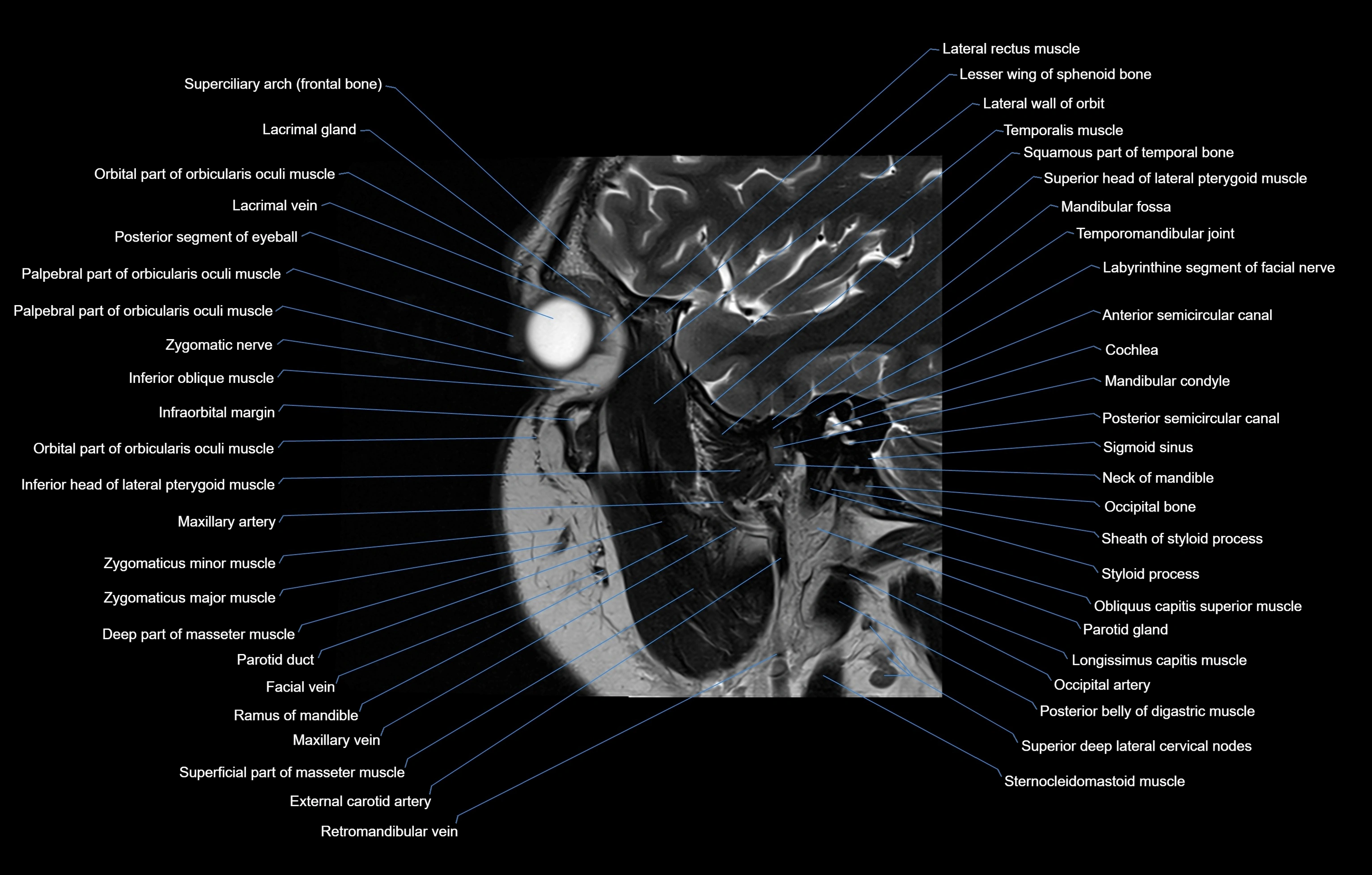paranasal sinuses(PNS) MRI coronal  cross sectional anatomy 3T radiology  image-img-00001-00017.webp